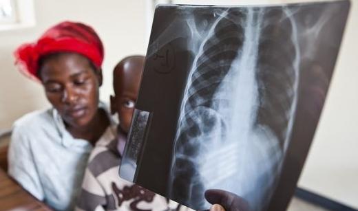 Aký príznak tuberkulózy u detí je považovaný za nástup ochorenia?
