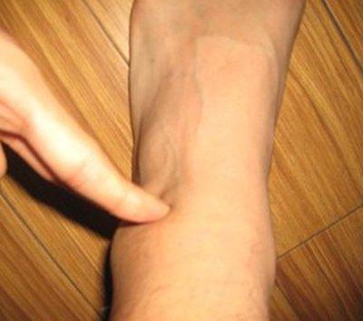 reaktívna artritída členkového kĺbu 