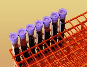 Analýza hemoglobínu v laboratóriu