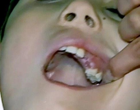 molárne rezy zubov