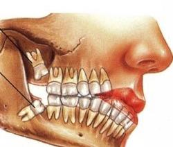 Zub múdrosti je príznaky rezu